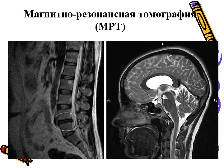 Магнитно-резонансная томография (МРТ) 