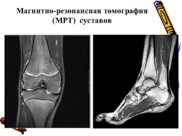 Магнитно-резонансная томография (МРТ) суставов 