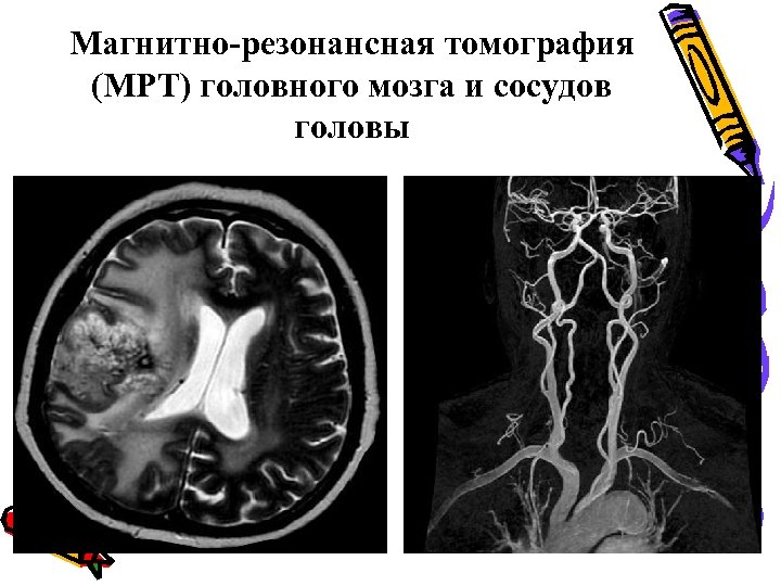 Мрт головы и сосудов. Мрт головного мозга и сосудов. Мрт головного мозга и сосудов рядом. Воспаление стенок сосудов головного мозга на мрт. Здоровое описание томографии головного мозга и сосудов.