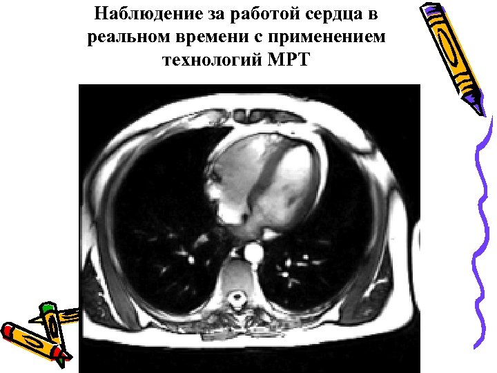 Наблюдение за работой сердца в реальном времени с применением технологий МРТ 