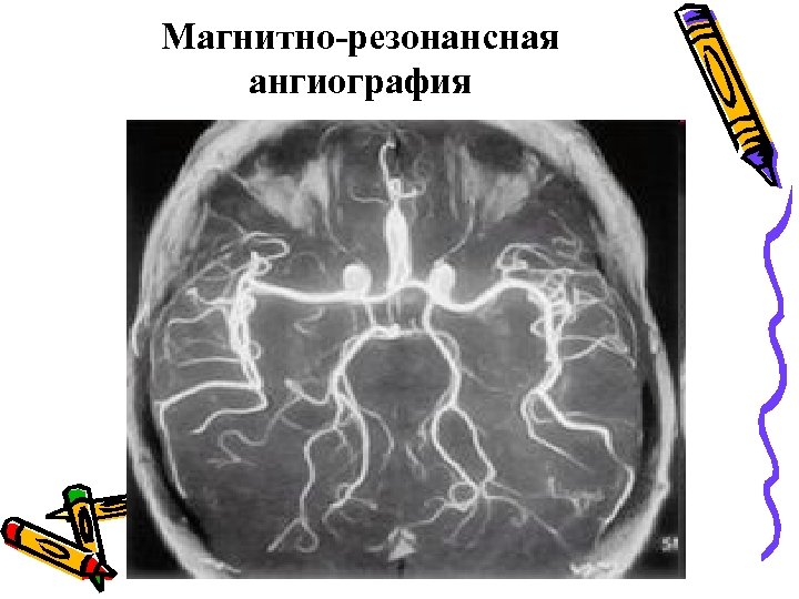 Магнитно-резонансная ангиография 