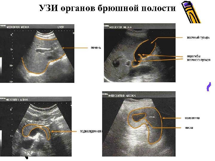 Узи брюшной полости врачи отзывы. Ультразвуковое исследование брюшной полости. Ультразвуковое исследование органов брюшной полости комплексное. УЗИ органов брюшной полости технология. УЗИ брюшной полости на полный мочевой пузырь или нет.