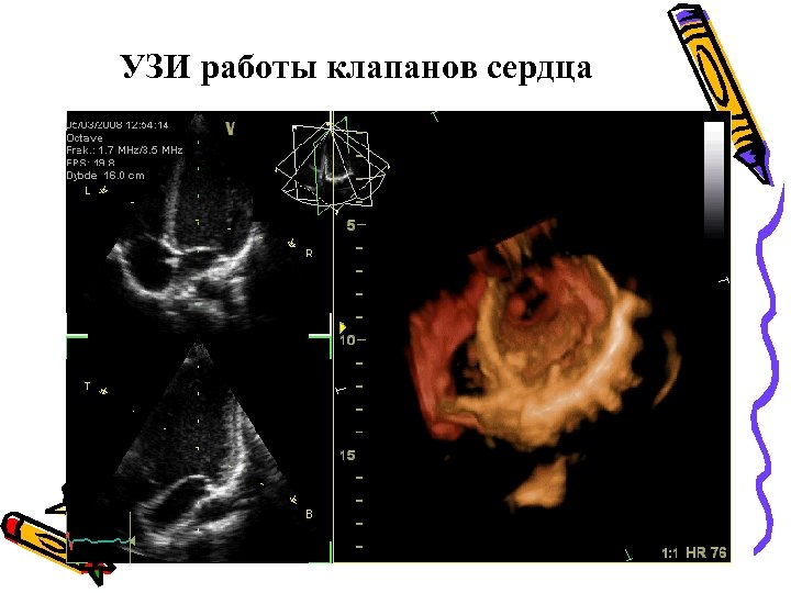 УЗИ работы клапанов сердца 