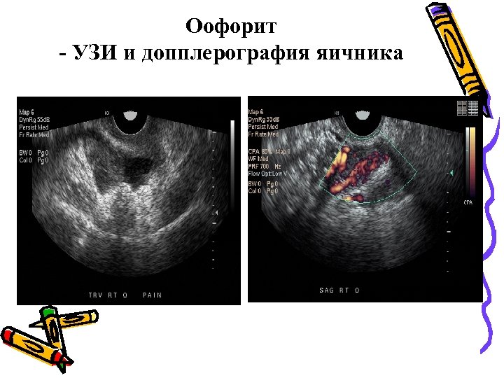 Оофорит - УЗИ и допплерография яичника 