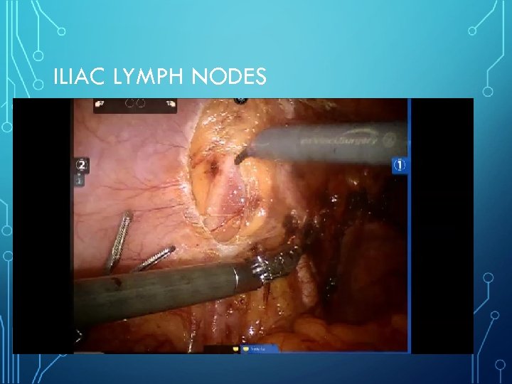 ILIAC LYMPH NODES 