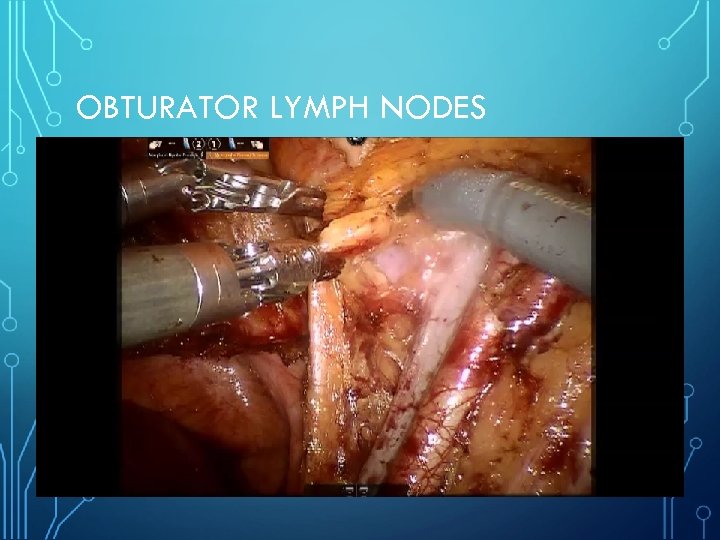OBTURATOR LYMPH NODES 