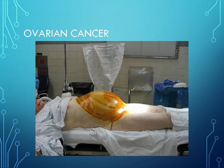 OVARIAN CANCER 