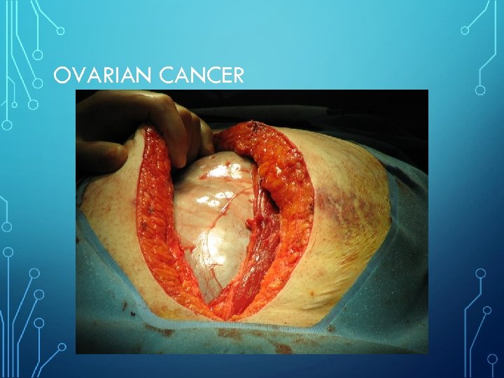 OVARIAN CANCER 