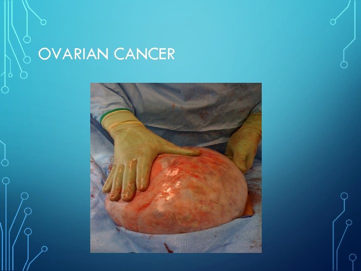 OVARIAN CANCER 