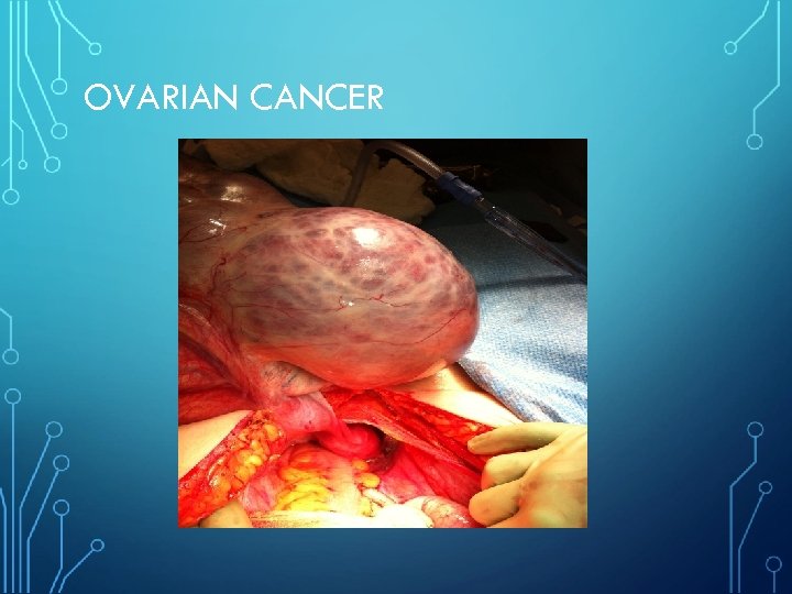 OVARIAN CANCER 