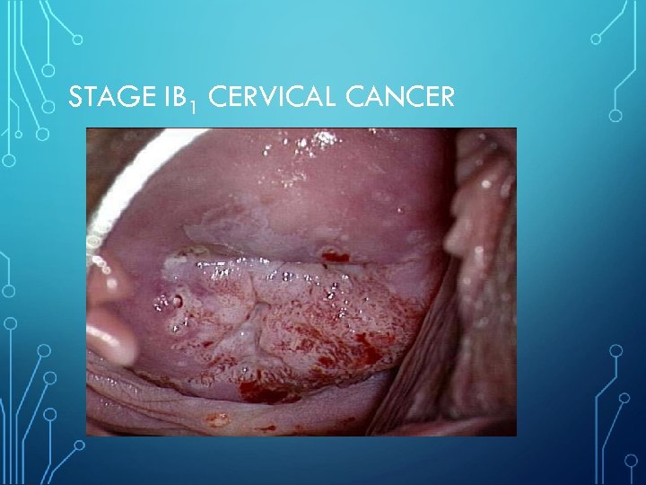 STAGE IB 1 CERVICAL CANCER 