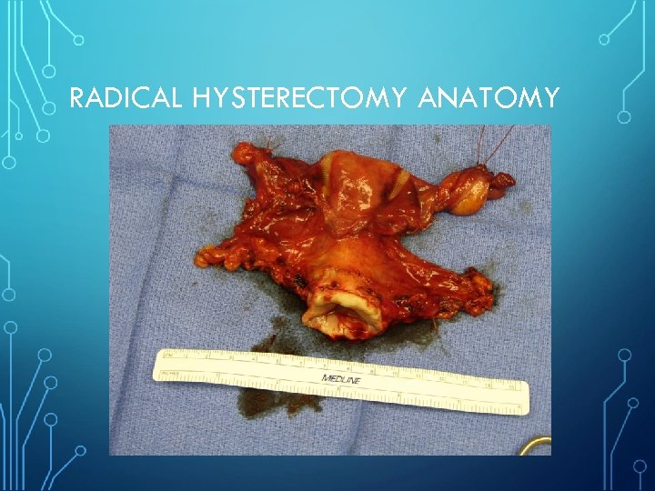 RADICAL HYSTERECTOMY ANATOMY 
