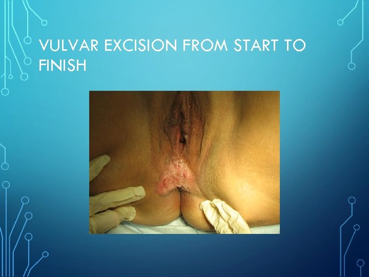 VULVAR EXCISION FROM START TO FINISH 