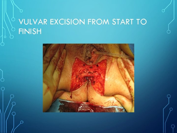 VULVAR EXCISION FROM START TO FINISH 
