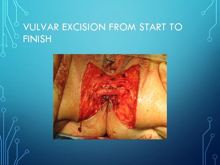 VULVAR EXCISION FROM START TO FINISH 