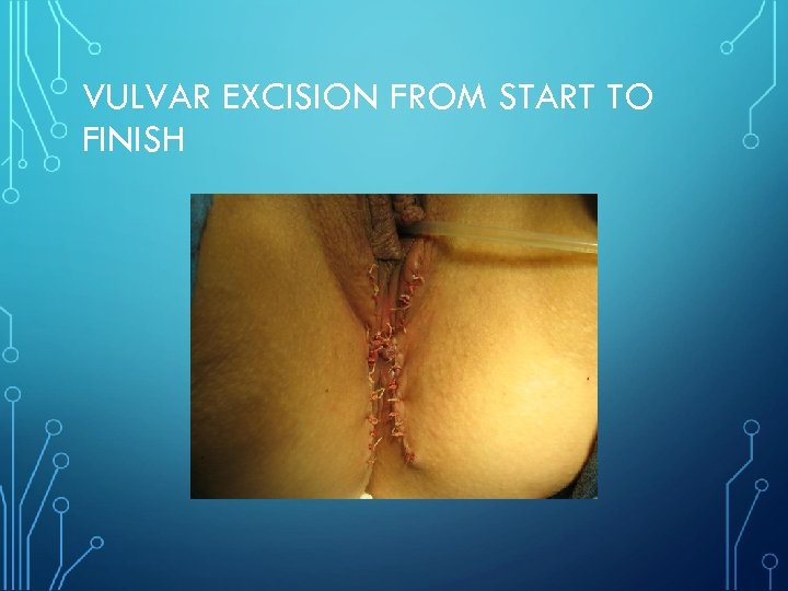 VULVAR EXCISION FROM START TO FINISH 