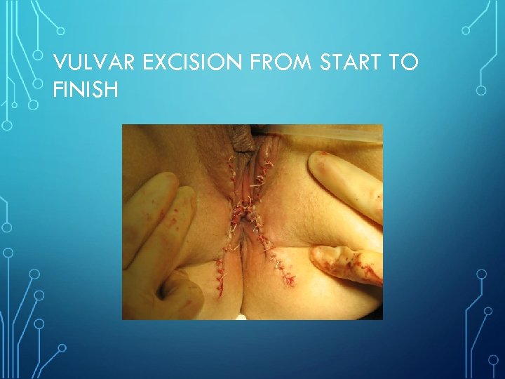 VULVAR EXCISION FROM START TO FINISH 