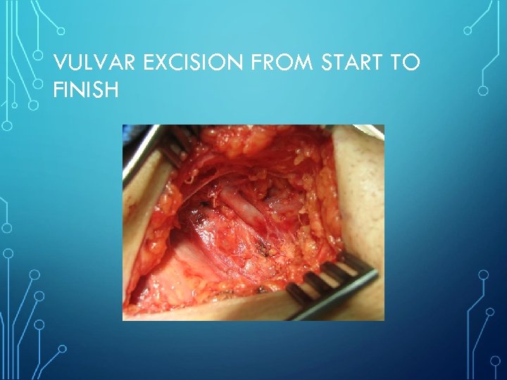 VULVAR EXCISION FROM START TO FINISH 