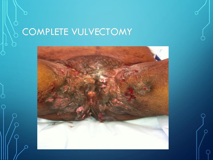 COMPLETE VULVECTOMY 