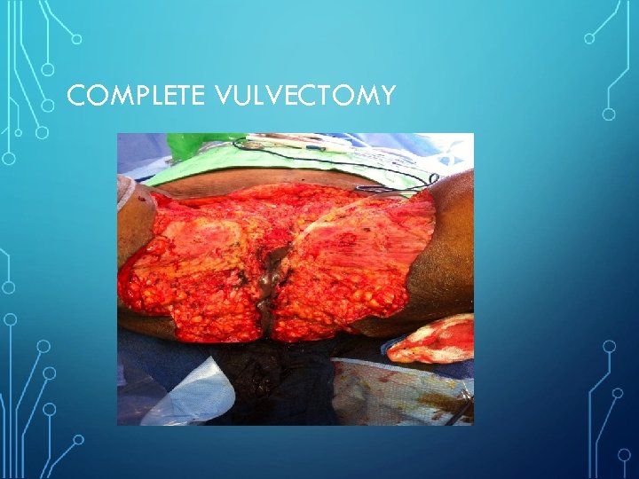 COMPLETE VULVECTOMY 
