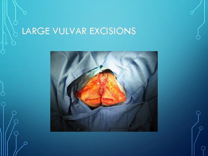 LARGE VULVAR EXCISIONS 