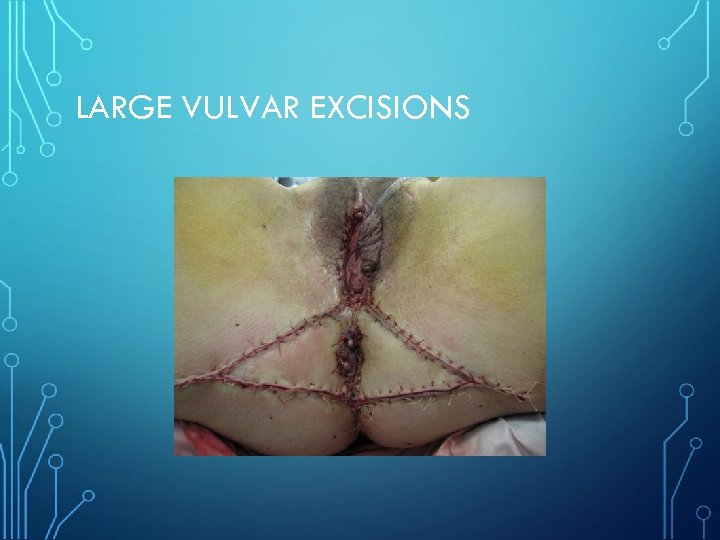 LARGE VULVAR EXCISIONS 