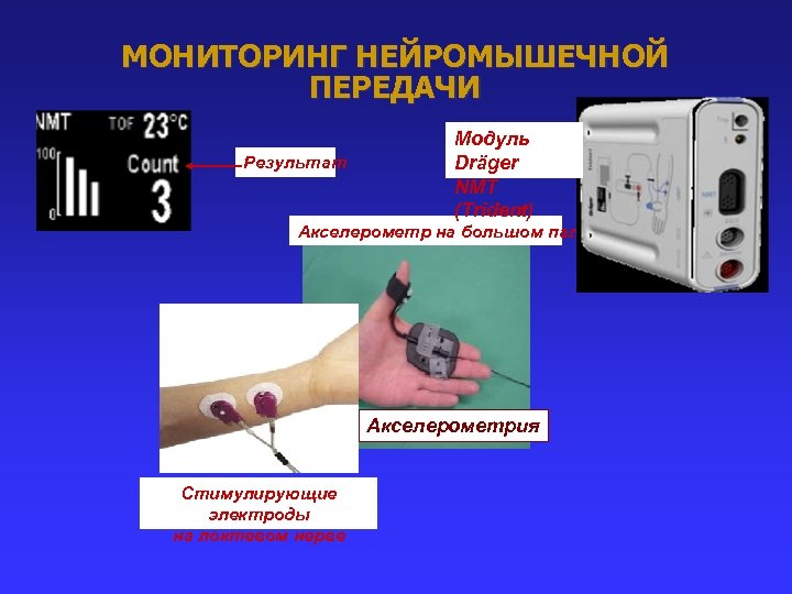 МОНИТОРИНГ НЕЙРОМЫШЕЧНОЙ ПЕРЕДАЧИ Результат Модуль Dräger NMT (Trident) Акселерометр на большом пальце Акселерометрия Стимулирующие