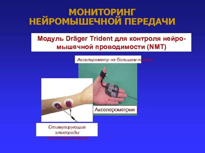 МОНИТОРИНГ НЕЙРОМЫШЕЧНОЙ ПЕРЕДАЧИ Модуль Dräger Trident для контроля нейромышечной проводимости (NMT) Акселерометр на большом
