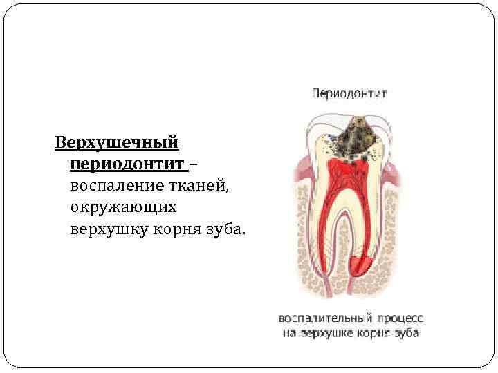 Верхушечный периодонтит – воспаление тканей, окружающих верхушку корня зуба. 