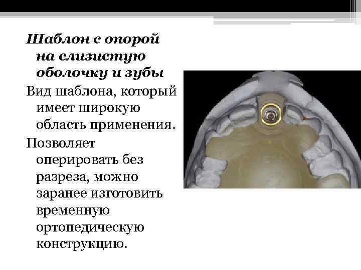 Шаблон с опорой на слизистую оболочку и зубы Вид шаблона, который имеет широкую область