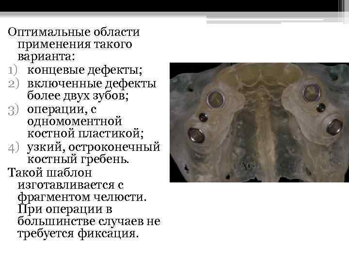 Оптимальные области применения такого варианта: 1) концевые дефекты; 2) включенные дефекты более двух зубов;