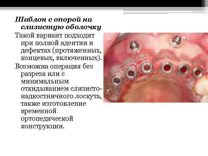 Шаблон с опорой на слизистую оболочку Такой вариант подходит при полной адентии и дефектах