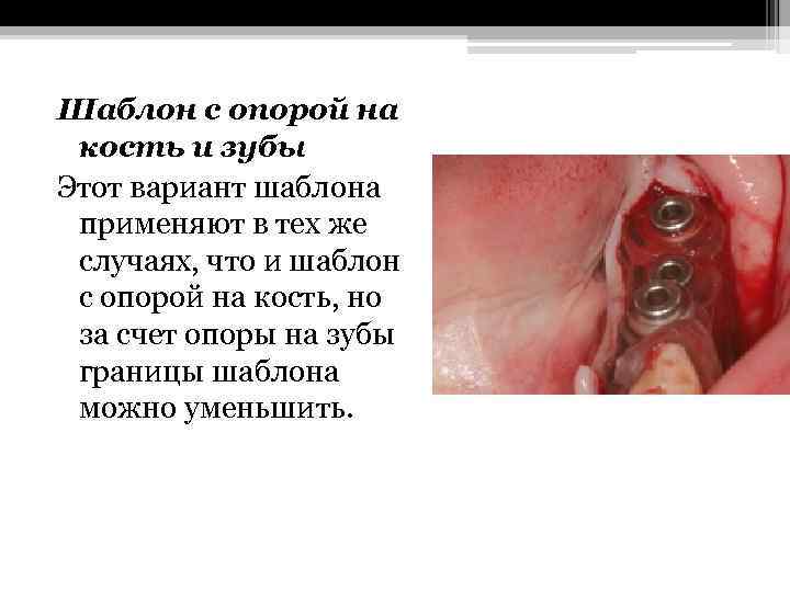 Шаблон с опорой на кость и зубы Этот вариант шаблона применяют в тех же
