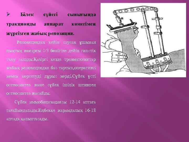 Ø Білек тракционды сүйегі аппарат сынығында көмегімен жүргізген жабық репозиция. Репозициядан кейін саусақ ұшынан