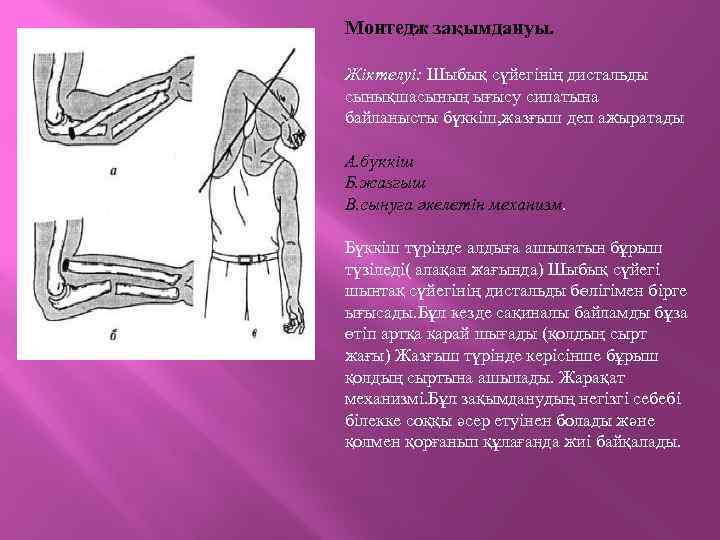 Монтедж зақымдануы. Жіктелуі: Шыбық сүйегінің дистальды сынықшасының ығысу сипатына байланысты бүккіш, жазғыш деп ажыратады