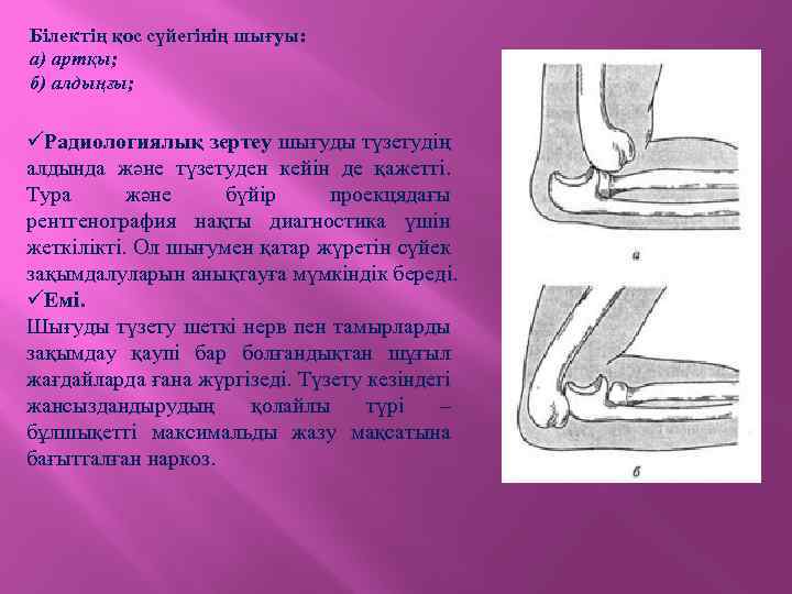 Білектің қос сүйегінің шығуы: а) артқы; б) алдыңғы; üРадиологиялық зертеу шығуды түзетудің алдында және