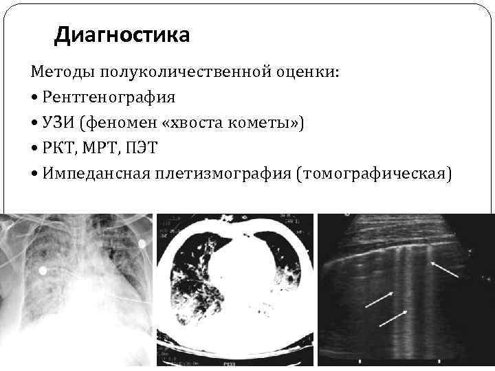 Диагностика Методы полуколичественной оценки: • Рентгенография • УЗИ (феномен «хвоста кометы» ) • РКТ,