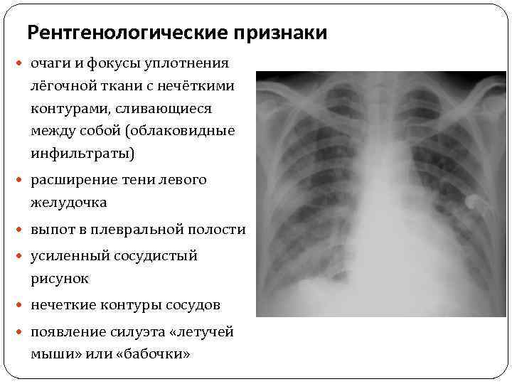 Усиленный сосудистый рисунок легких на рентгене что