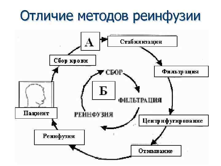 Отличие методов реинфузии 