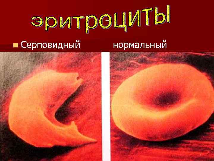 n Серповидный нормальный 