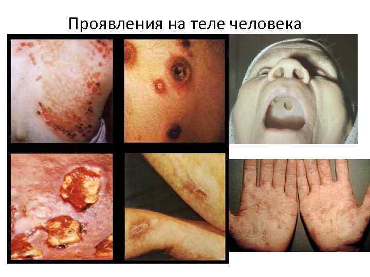 Проявления на теле человека 