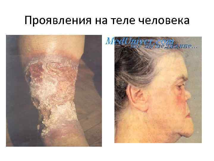 Проявления на теле человека 