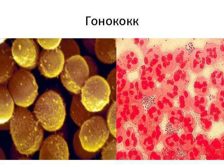Гонококк 