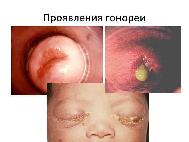 Проявления гонореи 
