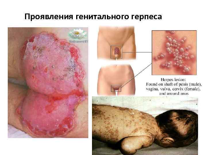 Проявления генитального герпеса 