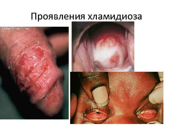 Проявления хламидиоза 