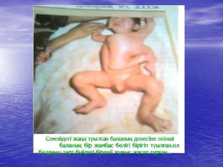 Семейдегі жаңа туылған баланың денесіне екінші баланың бір жамбас бөлігі бірігіп туылған. ол баланың