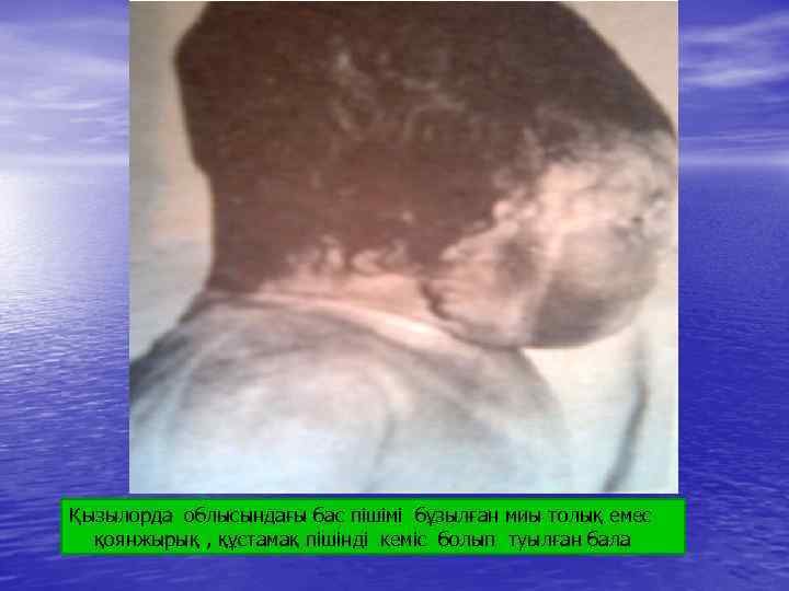 Қызылорда облысындағы бас пішімі бұзылған миы толық емес қоянжырық , құстамақ пішінді кеміс болып