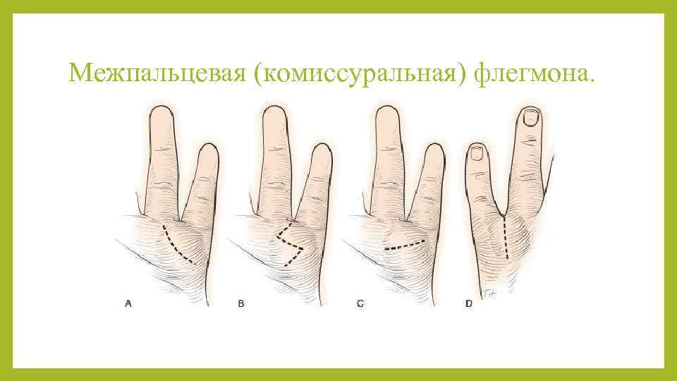 Межпальцевая (комиссуральная) флегмона. 