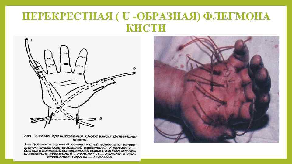 ПЕРЕКРЕСТНАЯ ( U -ОБРАЗНАЯ) ФЛЕГМОНА КИСТИ 